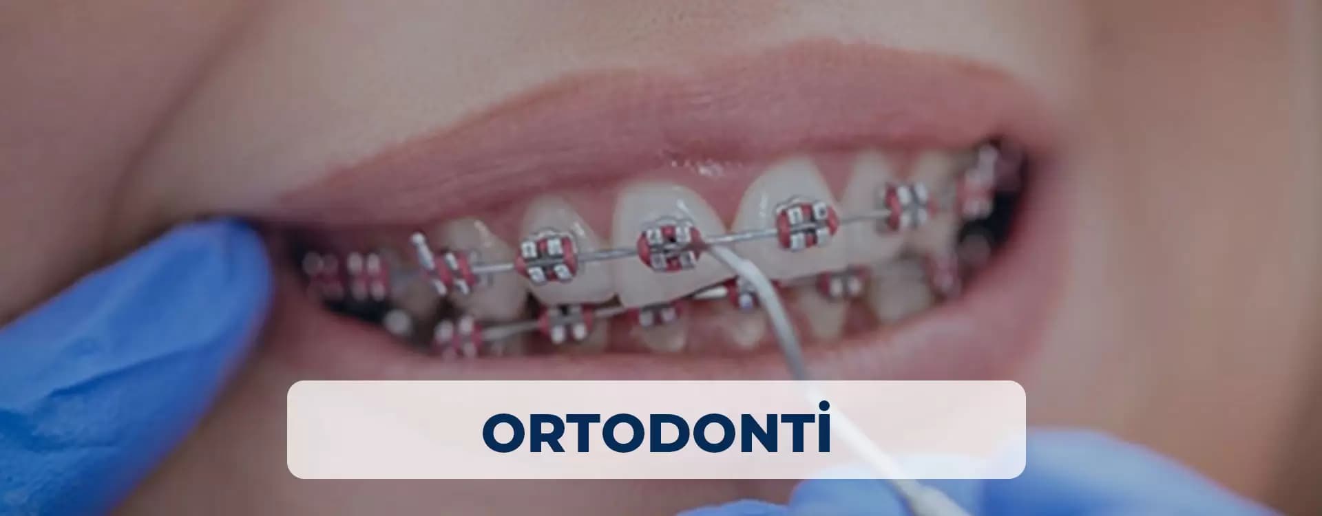 Ortodonti Tedavileri