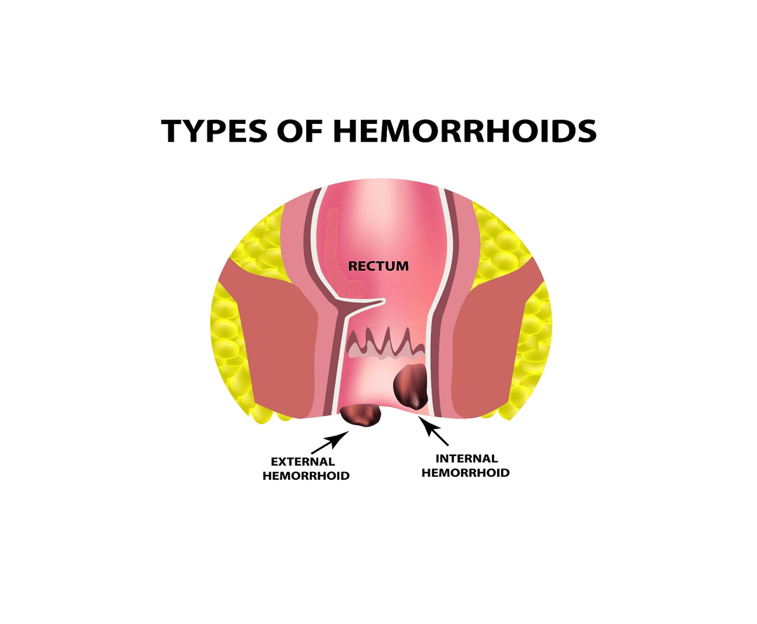 Hemoroid: Sessizce İlerleyen Rahatsızlık makalesini okuyarak detaylı bilgi edinin Hemoroid: Sessizce İlerleyen Rahatsızlık - Medibul sağlık rehberi uzman bilgilendirme görseli